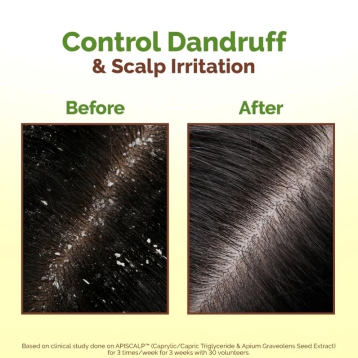Mamaearth Lemon Anti-Dandruff Hair Oil for Flaky Scalp Scalp
