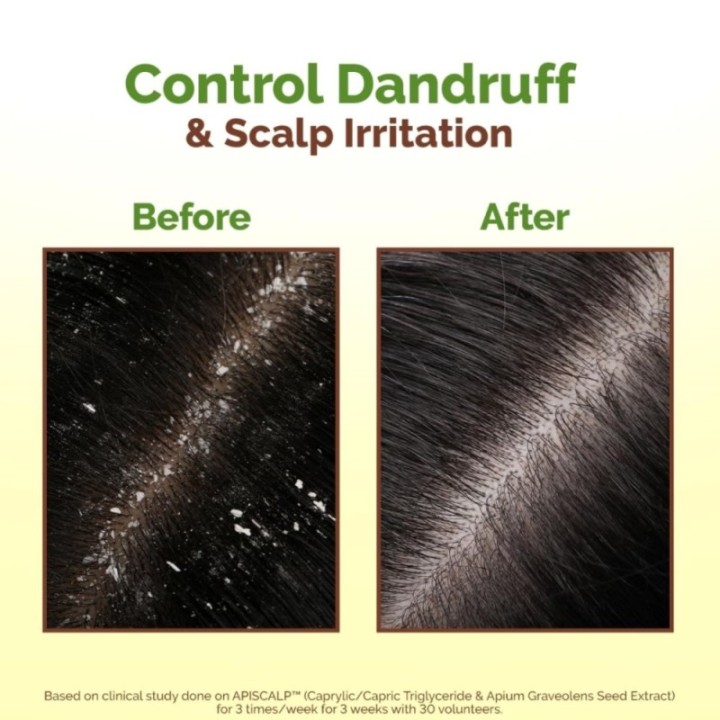 Mamaearth Lemon Anti-Dandruff Hair Oil for Flaky Scalp Scalp